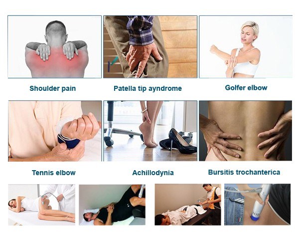 Physiotherapy Machine Shockwave Therapy for Heel Spur