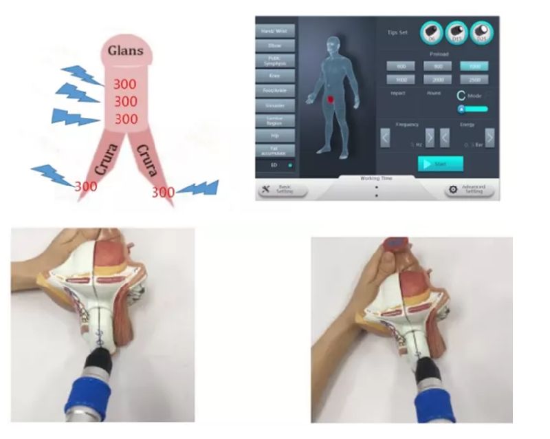 Shockwave Apparatus Shockwave Physiotherapy Instrument Eswt Focal