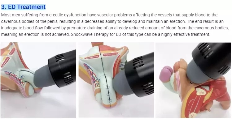 Anti-Cellulite Physiotherapy Device Shock Wave Therapy for ED Treatment