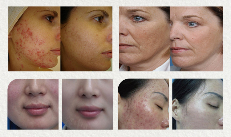 Photodynamic Therapy / Red Light Therapy / LED Light Therapy LED PDT