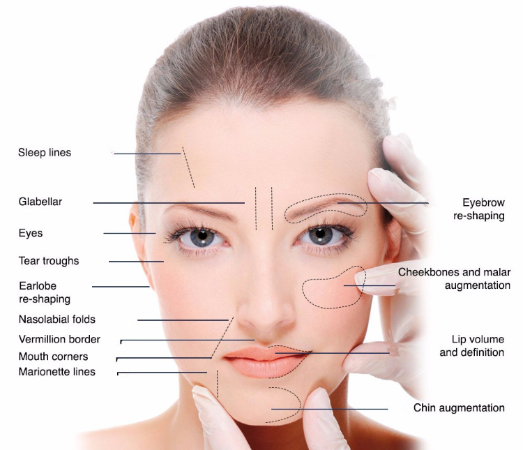 Anti-Wrinkles and Cheek Fullness Dermal Filler Hyaluronic Acid Gel Injection