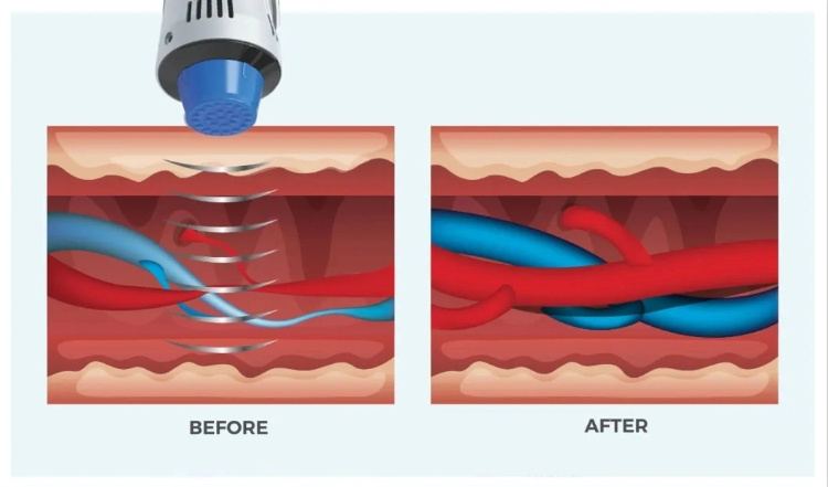 Physiotherapy Machine Shockwave Therapy for Body Beauty