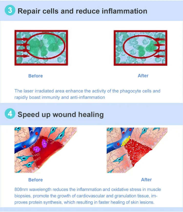 Electronic Low Level Cold Laser Therapy for Body Health Care