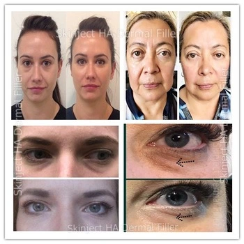 2020 Cosmetic Face Thin Type a 100iu Botox's Butula Meditoxin Botulinumtoxin Better Than Botox