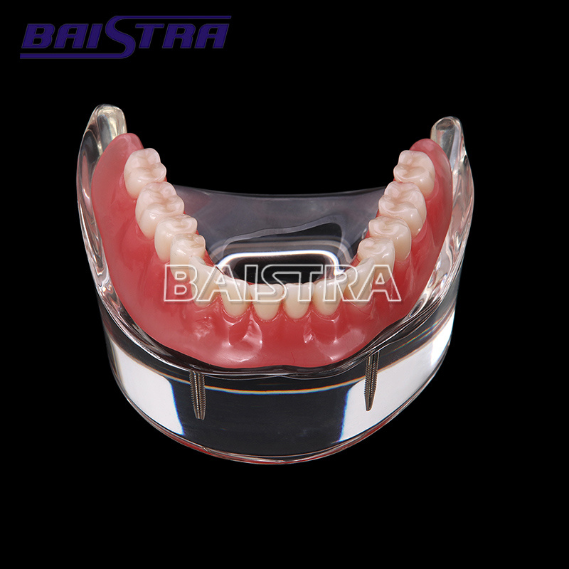 High Quality Overdenture Restoration Dental Implant Model/ Dental Teeth Model