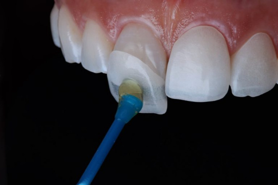 Ultra Thin 0.2mm Porcelain Dental Veneers Long Lasting Natural Looking