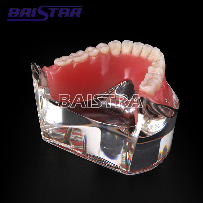 High Quality Overdenture Restoration Dental Implant Model/ Dental Teeth Model
