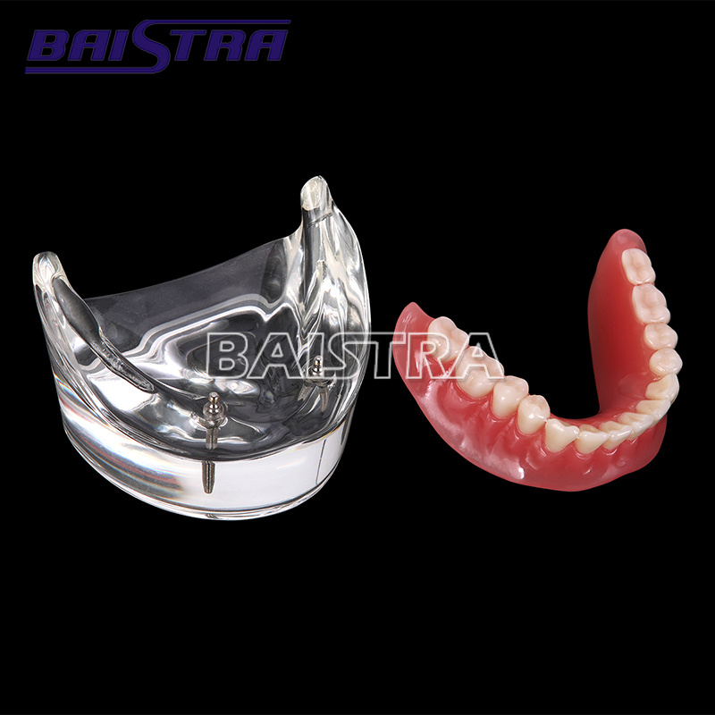 High Quality Overdenture Restoration Dental Implant Model/ Dental Teeth Model