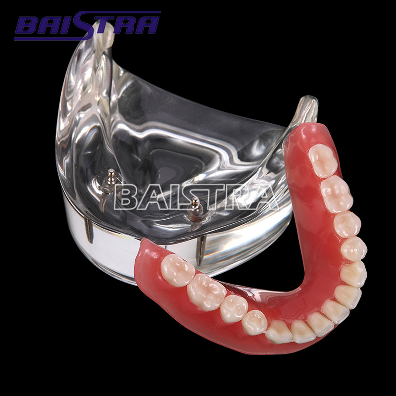 High Quality Overdenture Restoration Dental Implant Model/ Dental Teeth Model