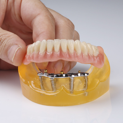 Removable Dental Implant Supported Dentures as Overdenture Attachments