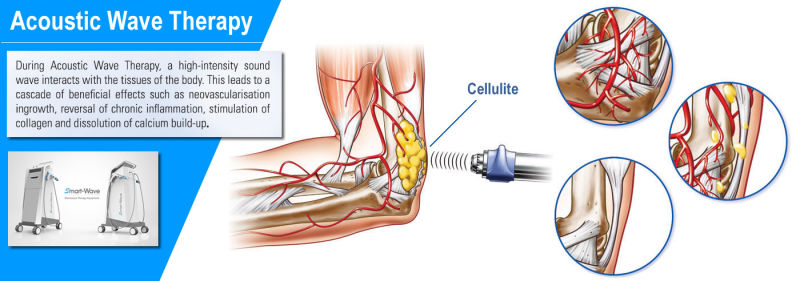 Amazon Bestseller Beauty Salon Acoustic Wave Therapy Equipment