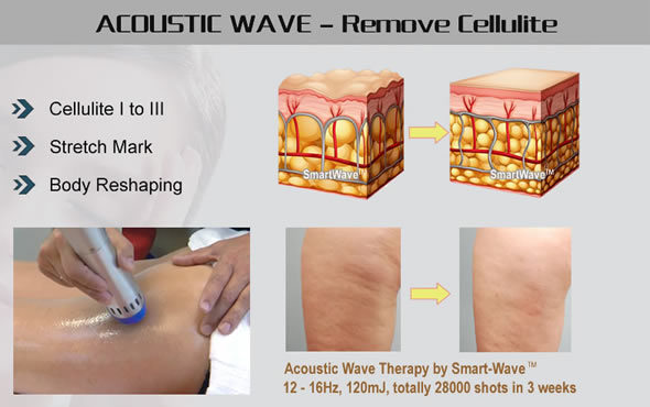 Amazon Bestseller Beauty Salon Acoustic Wave Therapy Equipment