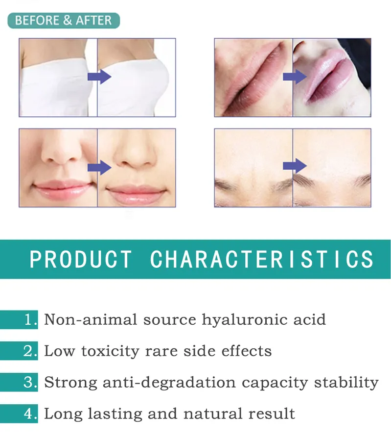 Charmost Deep Dermal Face Injection Fillers Injections for The Face 2 Ml