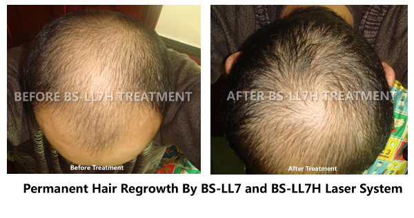 Medical Laser Therapy Equipment Red Light Therapy for Hair Loss