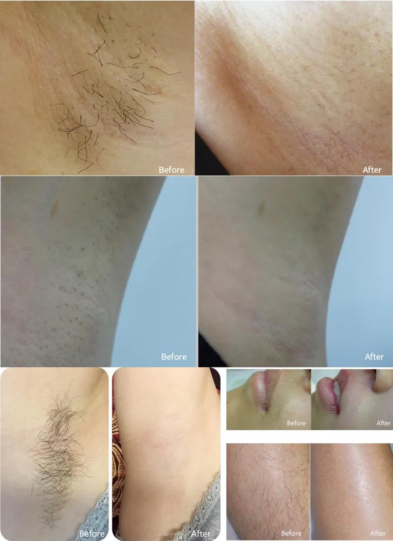 Groupon Laser Hair Removal Bikini Laser Hair Removal IPL Laser Hair Removal