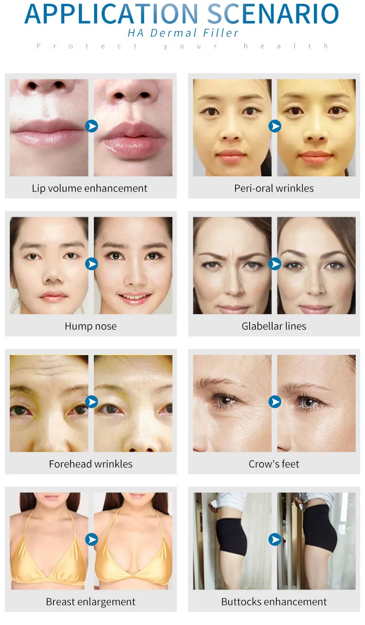 Remove Nasolabial Lines Breast 50ml Cross Linked Hyaluronic Acid Filler Injection in The Nose