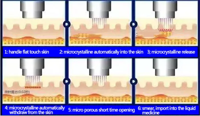 Professional Microneedling for RF Fraccionada Equipo De RF Microneedling Equipment