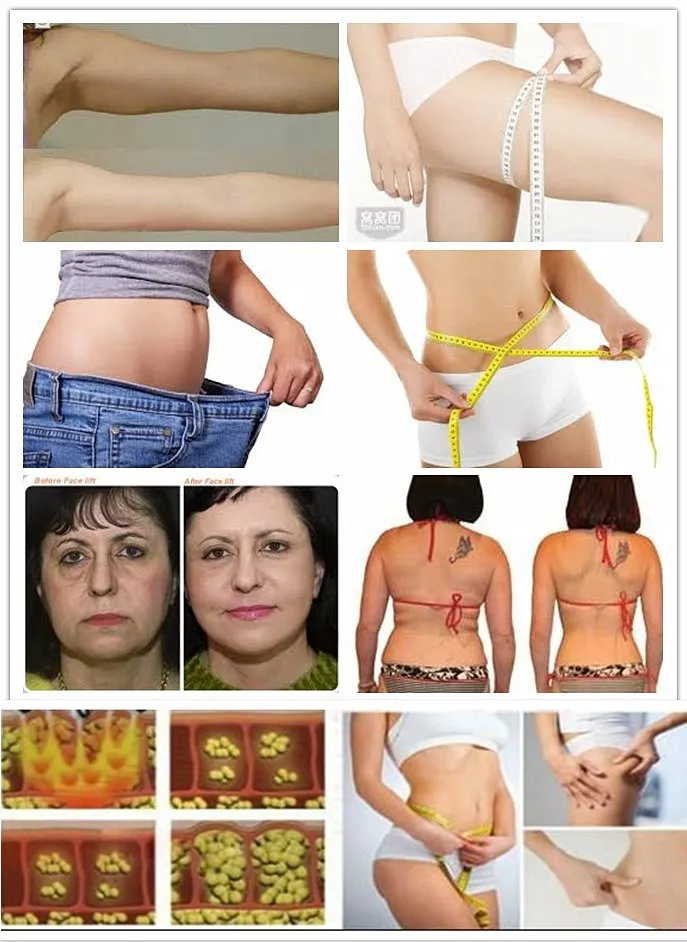 Ultrasonic Cavitation Cellulite Reduction