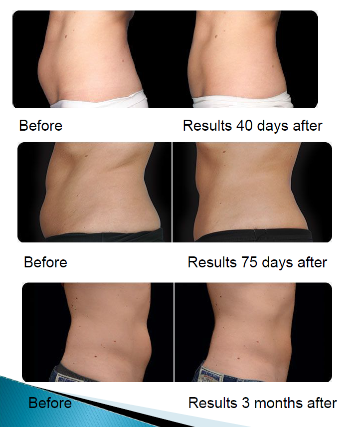 Velashape Radio Frequency Weight Loss Machine