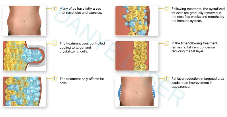 360 Cryolipolysis Vacuum Cavitation RF Double Chin Fat Freeze Machine