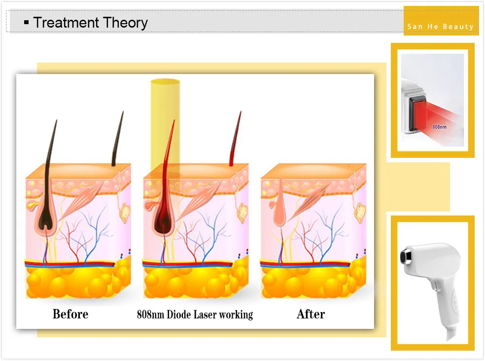 Strong Cooling Hair Removal 808nm Hair Removal