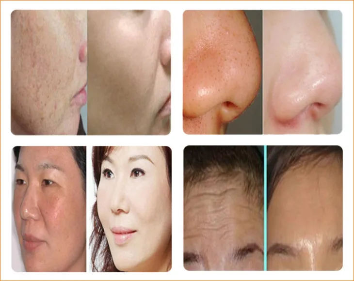 Permanent Tattoo Removal and Eyebrow Laser Tattoo Removal Beauty Equipment