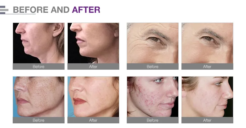 High Intensity and High Frequency Face Lift Fractional RF No Needles