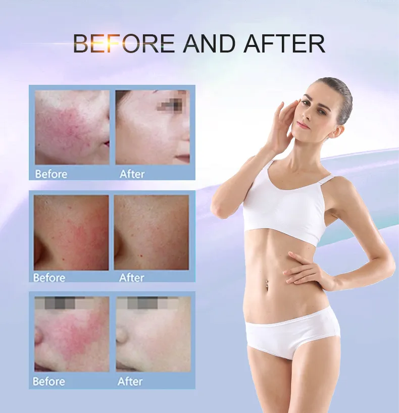 Most Effective Spider Veins Vascular Removal Machine Helium Skin Rejuvenation Skin Rejuvenator Mask