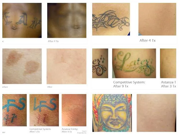 Laser Tattoo Removal Q Switch ND YAG Laser Machine