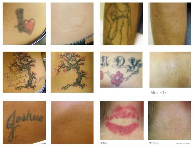 Laser Tattoo Removal Q Switch ND YAG Laser Machine