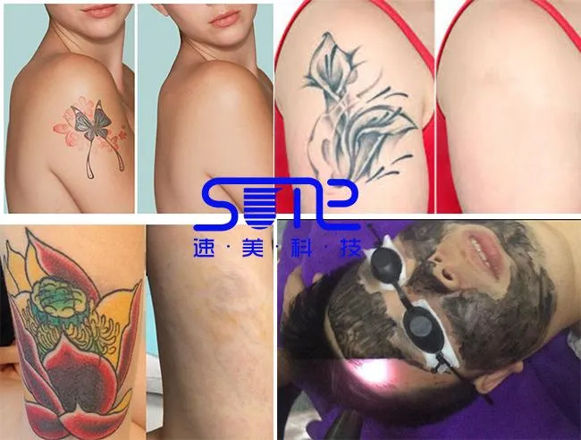 1064nm/532nm/1320nm ND YAG Q Switch Laser Tattoo Removal Beauty Equipment