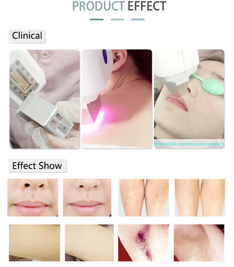 Hair Removal Expert Professional Laser Epilation Permanent Diode Laser