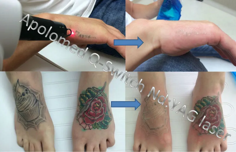 Non Invasive Tattoo Removal Laser Removal of Tattoos Tattoo Removal Machine