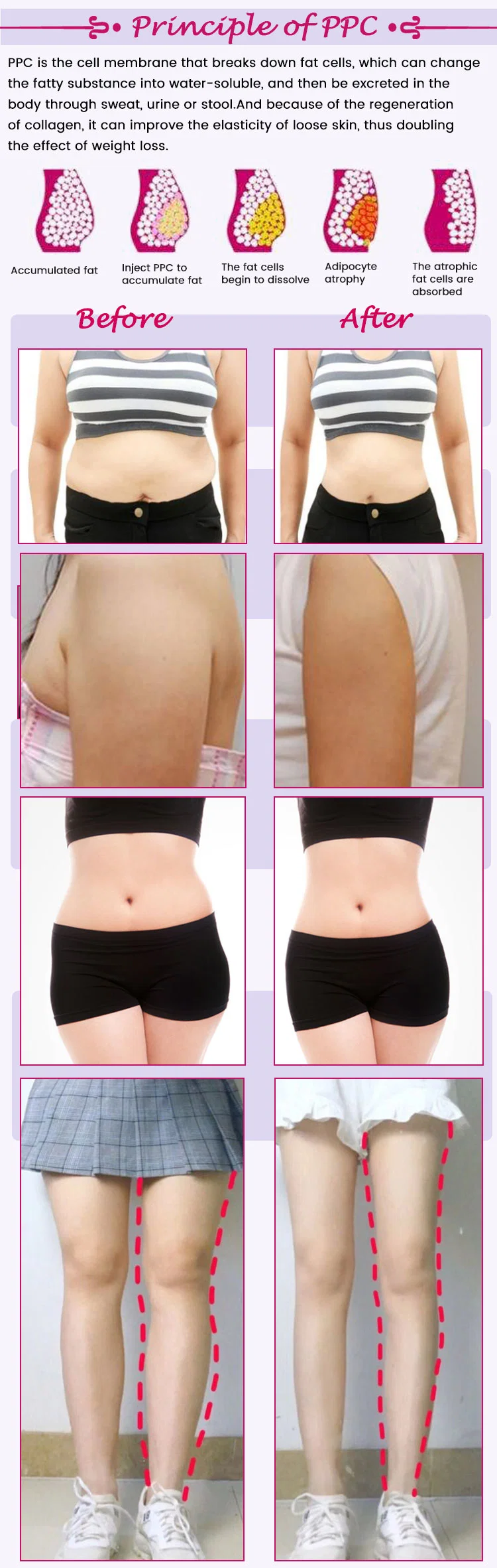 Korea Plant Extracts Lipolysis Slimming Solution Injection for Melting Subcutaneous Fat