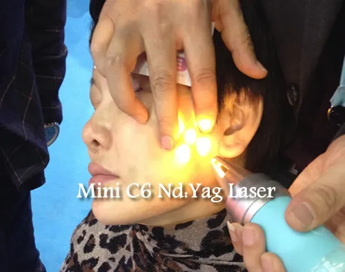 Laser Tattoo Removal Q Switch ND YAG Laser Machine