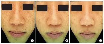 Q Switch Laser Pico Laser Tattoo Removal Machine