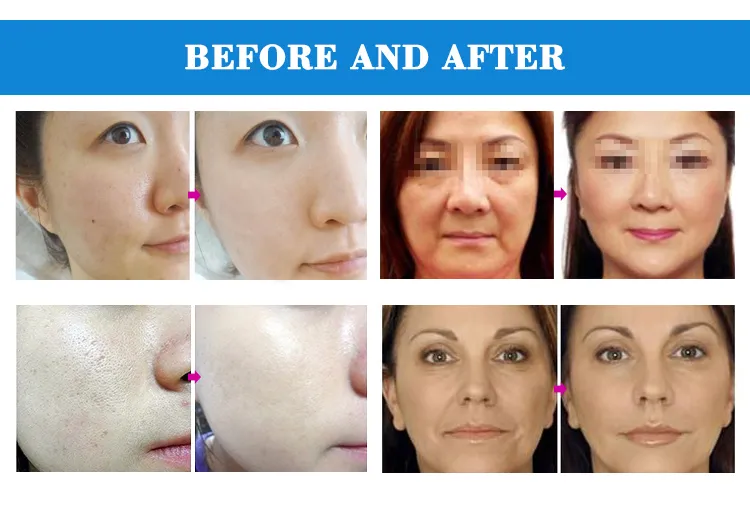 Cheap Price EMS LED Cool Face Lift Radio Frequency Facial Machine