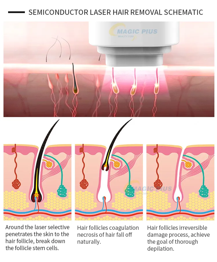 Alexandrite 755nm 808nm 1064nm Diode Laser 808 Nm Laser Hair Removal Machine Price