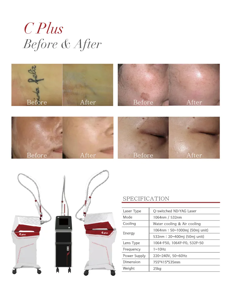 Laser ND YAG Q-Switched Laser Acne Removal Machine