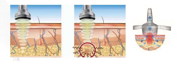 China Best New Ultrasonic RF Skin Tightening Machine