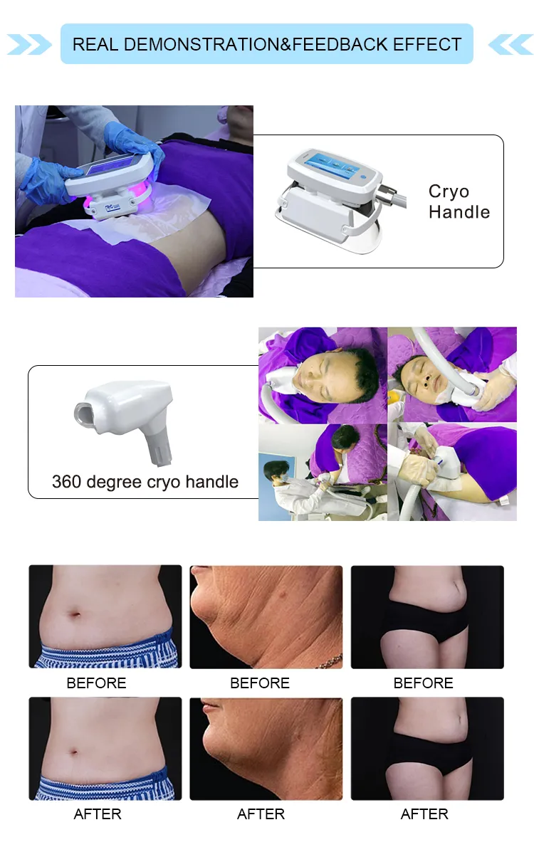 5 Handles Double Chin Fat Freezing Criolipolisis Cellulite Machine Cryolipolysis