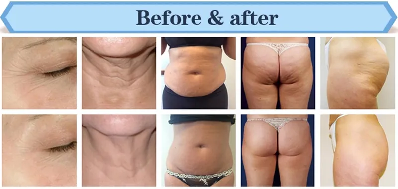 Multifunction Hydrodynamic Ultra Cavitation Professional 7 in 1 Cavitation Machine