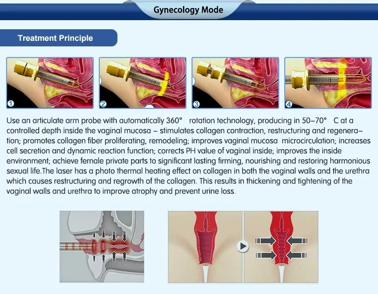 Skin Laser CO2 Skin Excision Vaginal Tightening