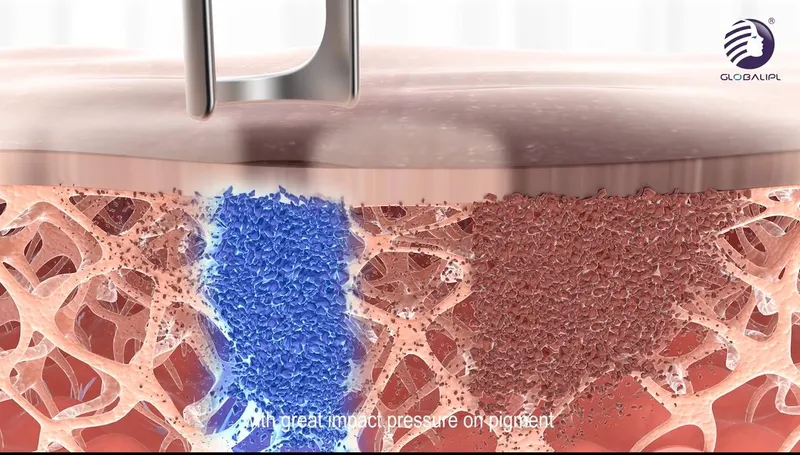 755nm Pico Laser ND YAG Beauty Q-Switched Laser Machine Tattoo Removal