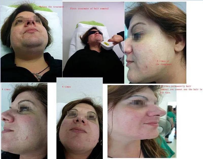 Laser Hair Removal 808nm / Alexandrite Laser Candela Laser Hair Removal Machine