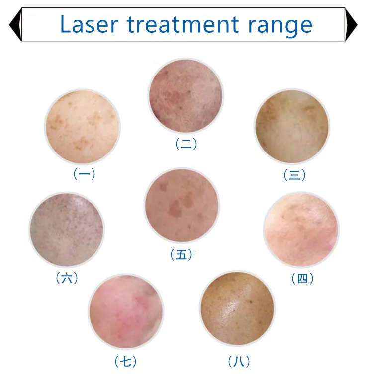 RF Face Lifting Q-Switched Laser & Opt Shr Hair Removal Machine