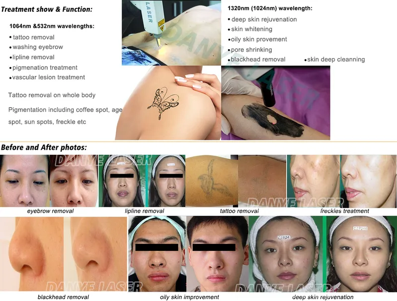 ND YAG Carbon Facial Laser Tattoo Removal Skin Beauty Equipment