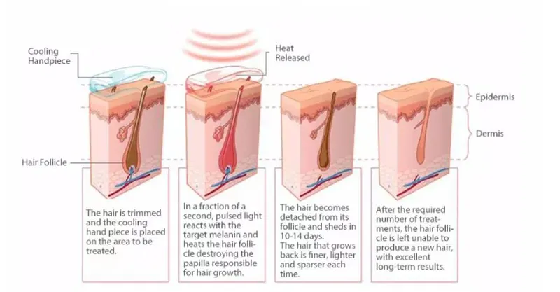 808nm Permanent Hair Removal Hair Depilator 808nm Diode Laser