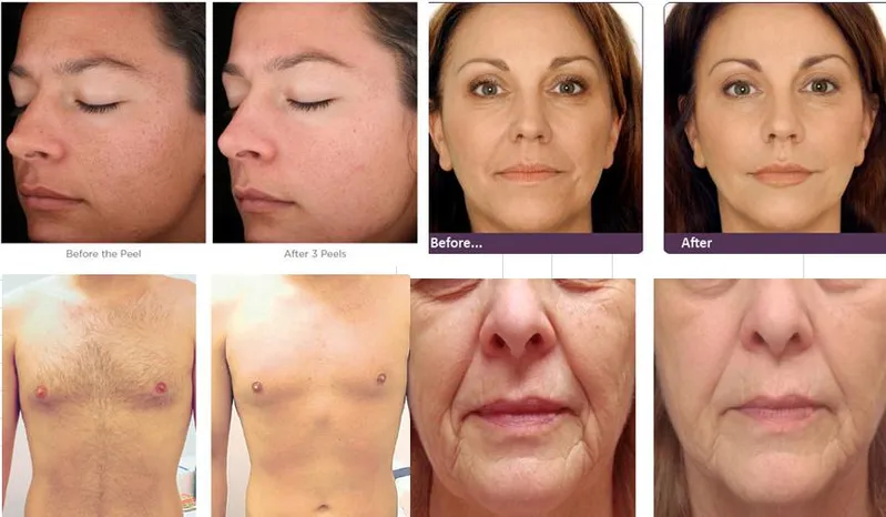 Floor Standing IPL Shr Hair Removal and IPL Skin Rejuvenation