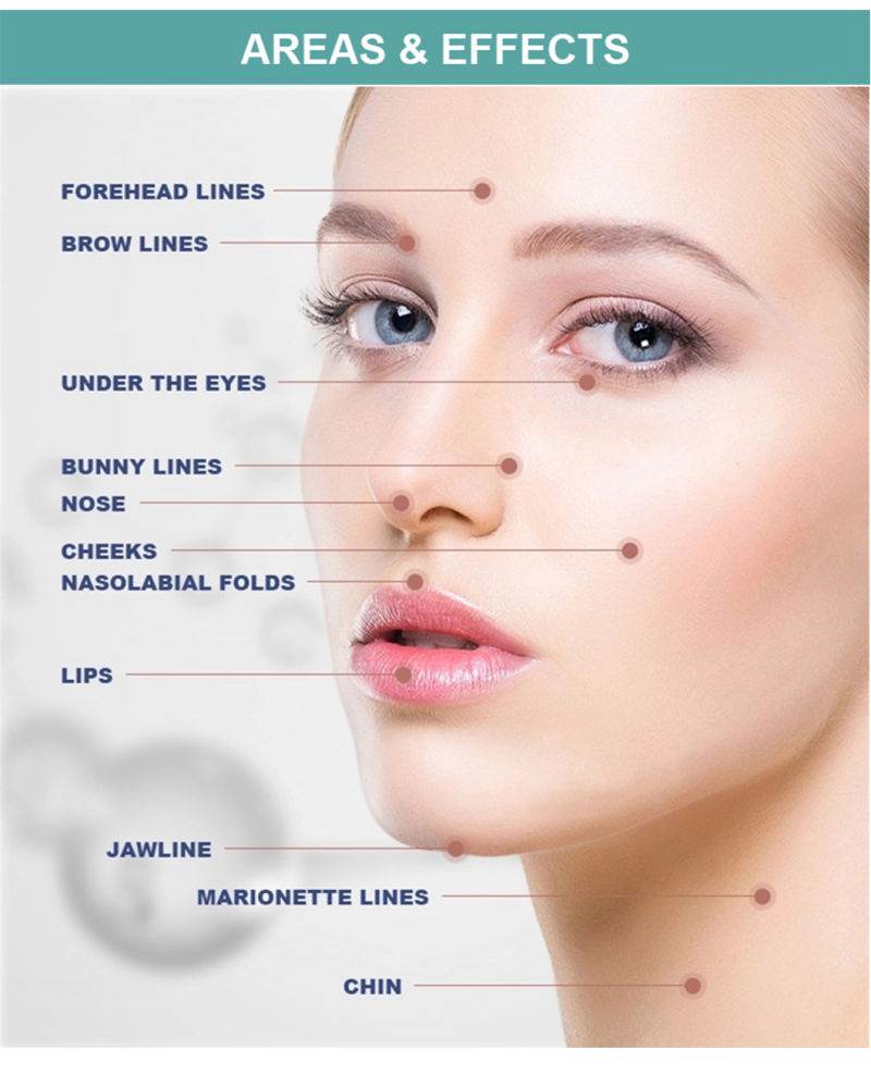 Charmost Deep Dermal Face Injection Fillers Injections for The Face 2 Ml